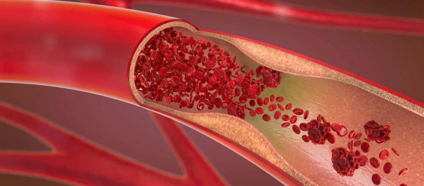 Εμβόλιο AstraZeneca: Γερμανός επιστήμονας υποστηρίζει ότι βρήκε την αιτία πρόκλησης θρομβώσεων (βίντεο)